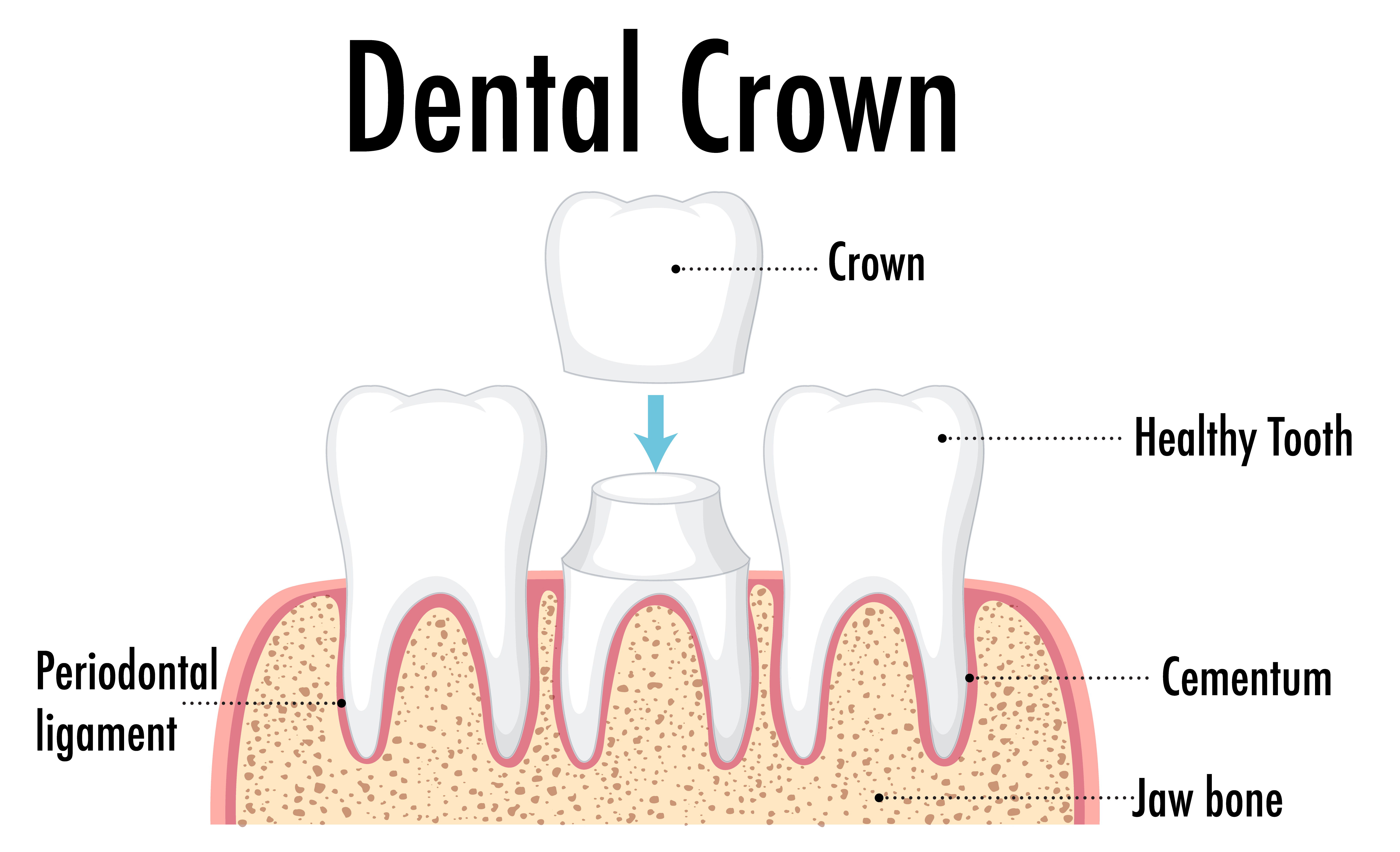 Crowns