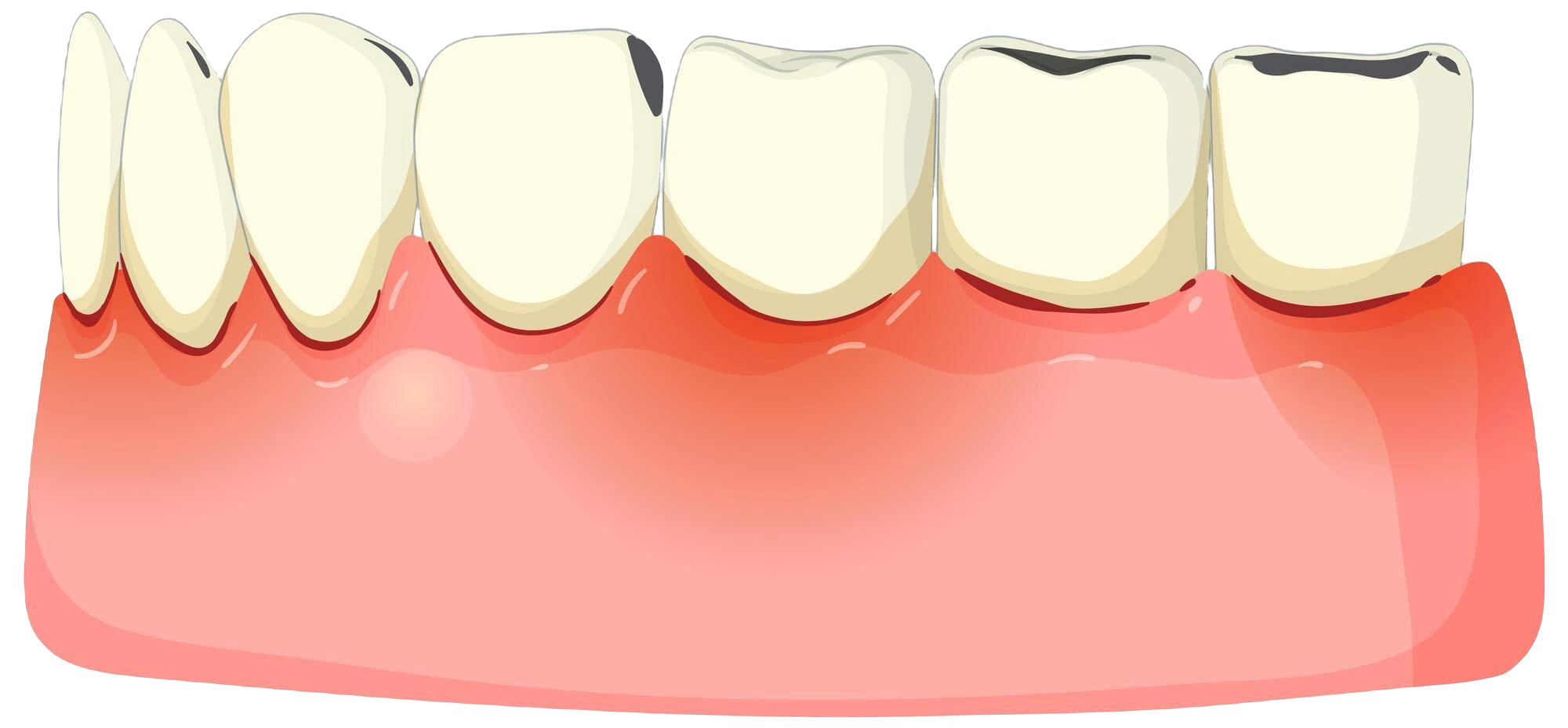 Gum Disease Treatment