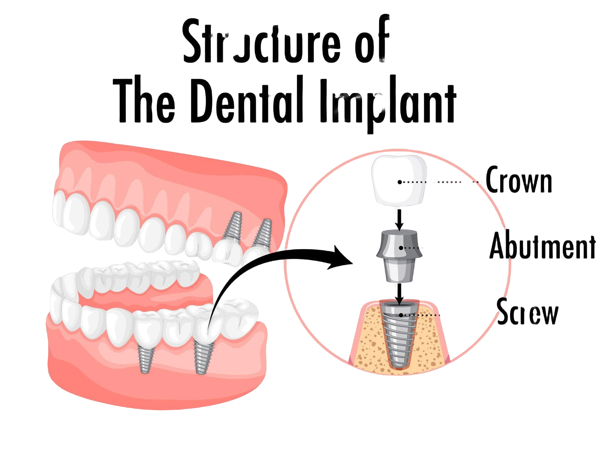 Dental Implants