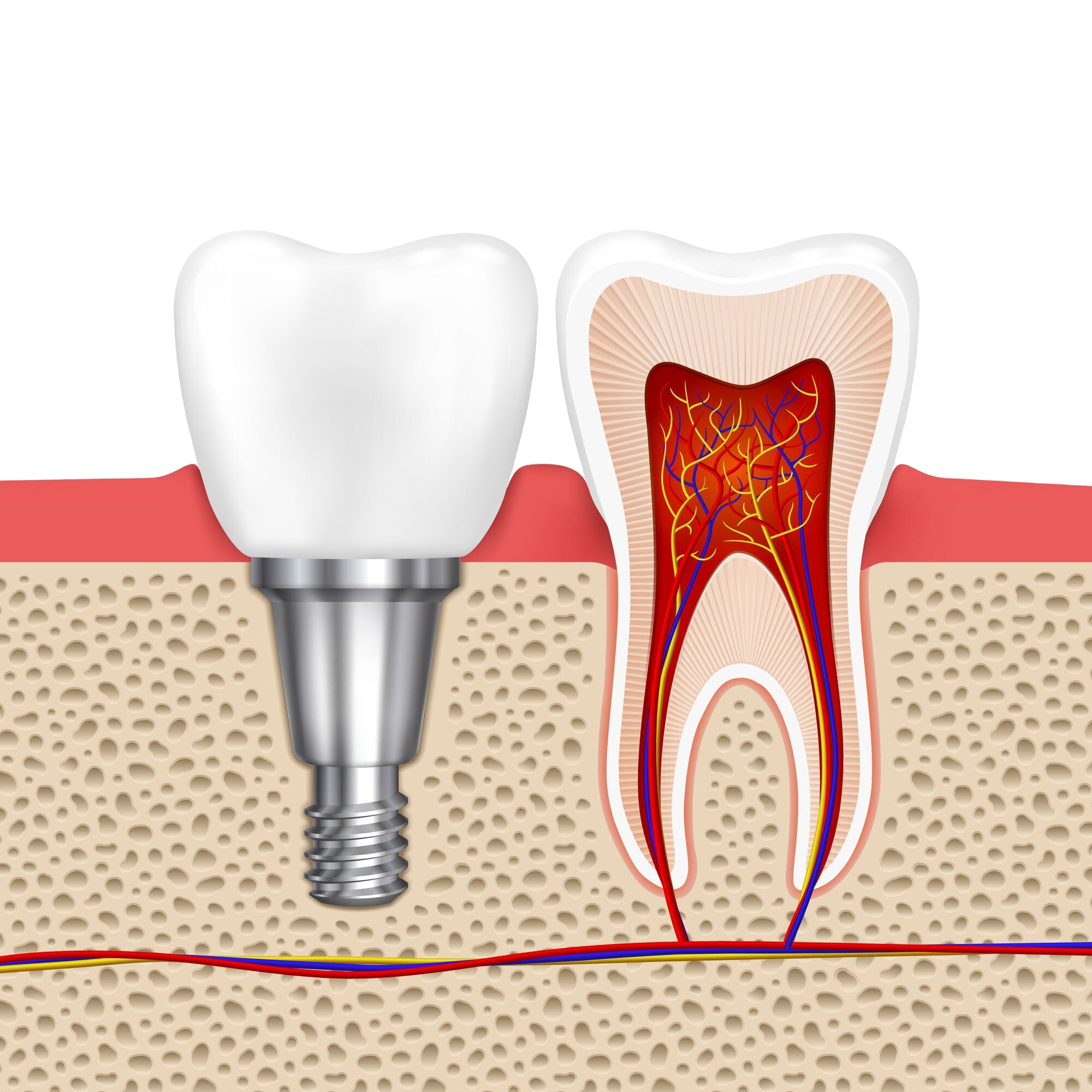 Root Canals